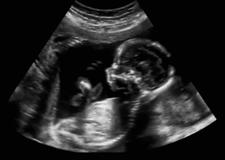 Baby Ultrasound